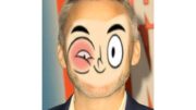 Pinkeye Craig Smith